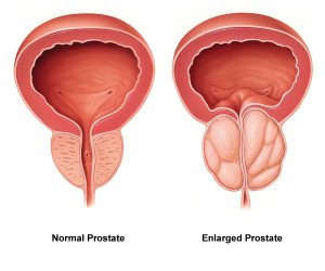 prostate scan